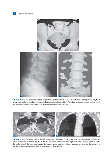 Coluna Vertebral