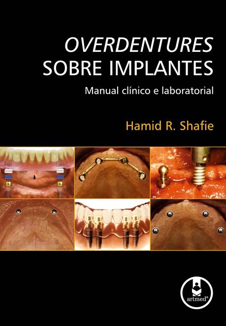 Overdentures Sobre Implantes