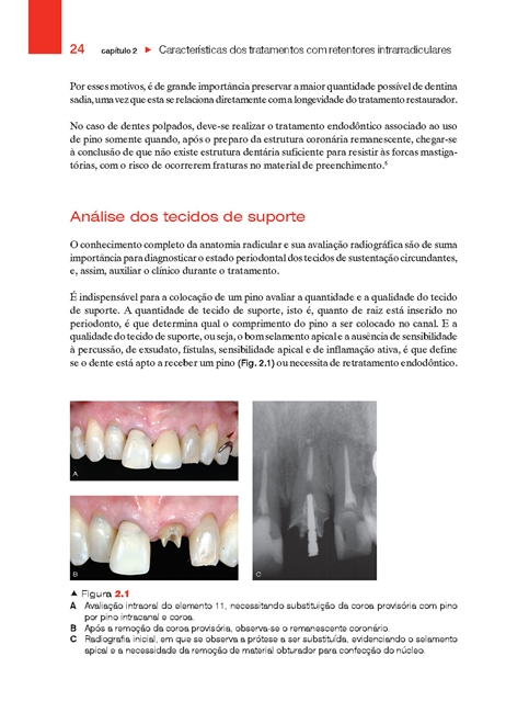 Retentores Intrarradiculares