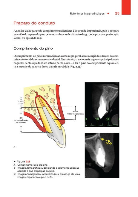 Retentores Intrarradiculares