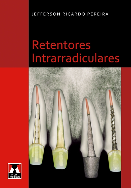 Retentores Intrarradiculares