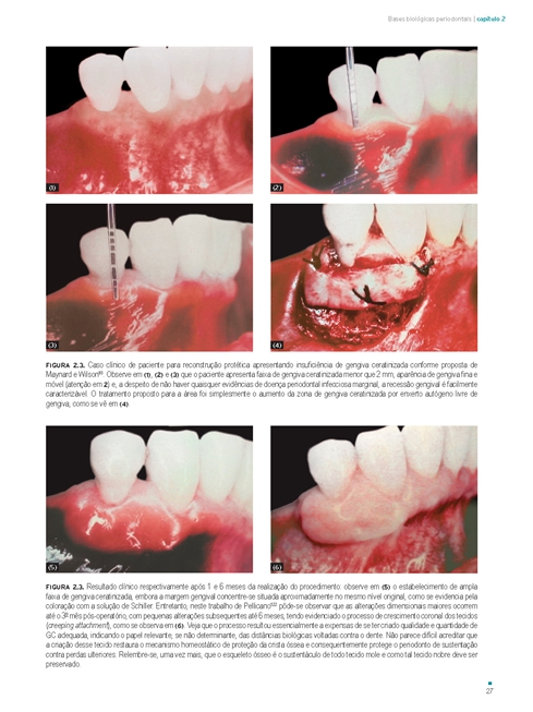 Distâncias Biológicas Periodontais