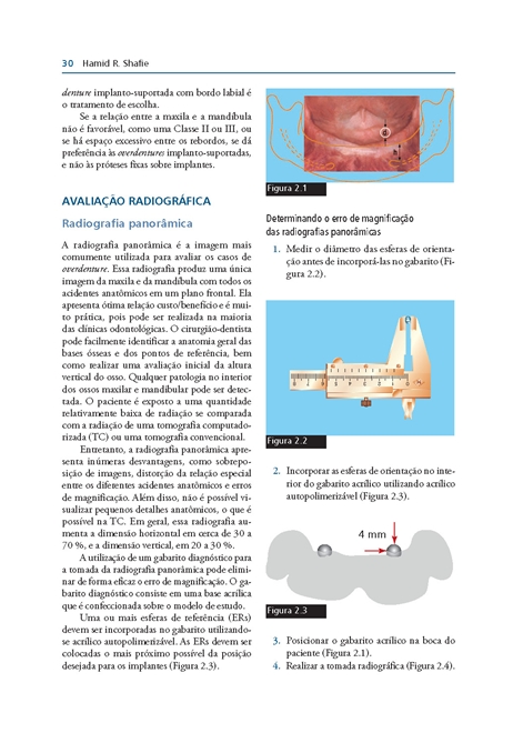 Overdentures Sobre Implantes