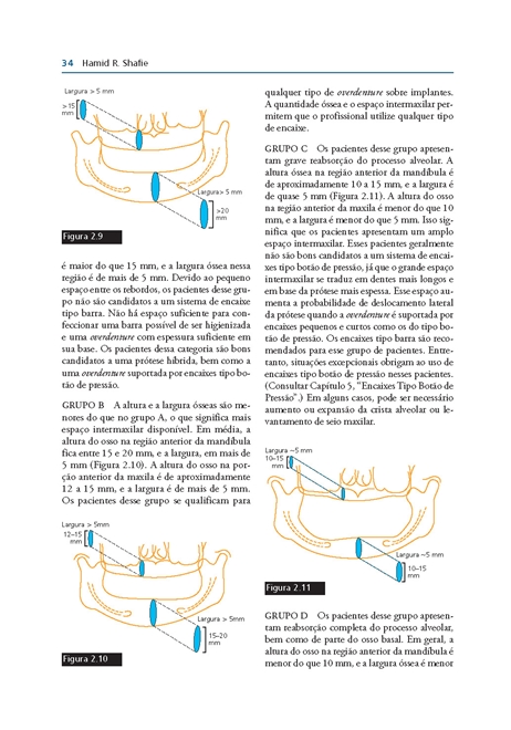 Overdentures Sobre Implantes