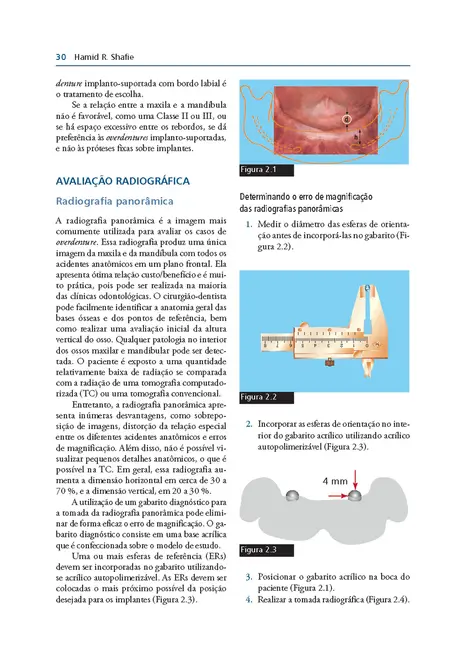 Overdentures Sobre Implantes