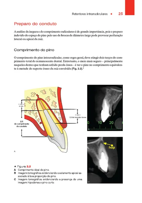 Retentores Intrarradiculares